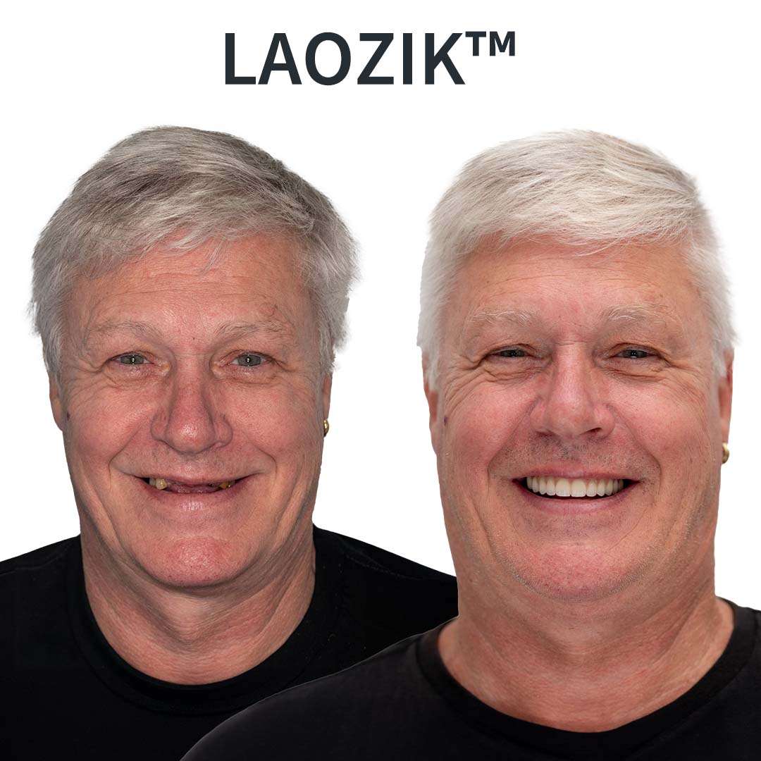 🌟Vásárolj 1 kapsz 1 ingyen😮 Arcmegereszkedést okozó fogsorok? EZ A készlet megállítja (fogorvosok által jóváhagyott!)